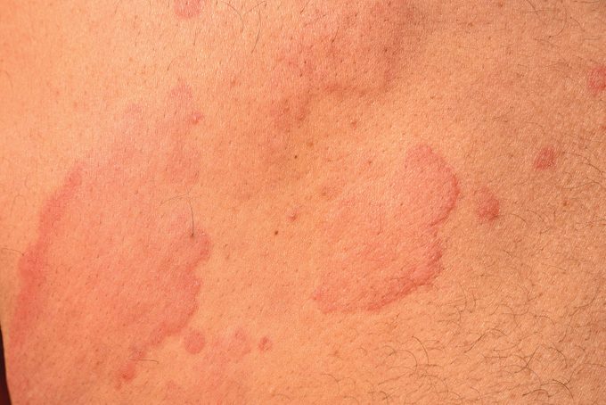 Hives - Urticaria, Skin Disease