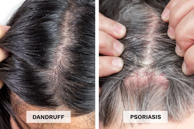 Dandruff Vs Psoriasis Pictures Side By Side