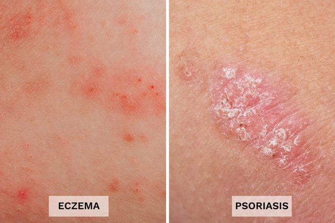 Eczema Vs Psoriasis Side By Side