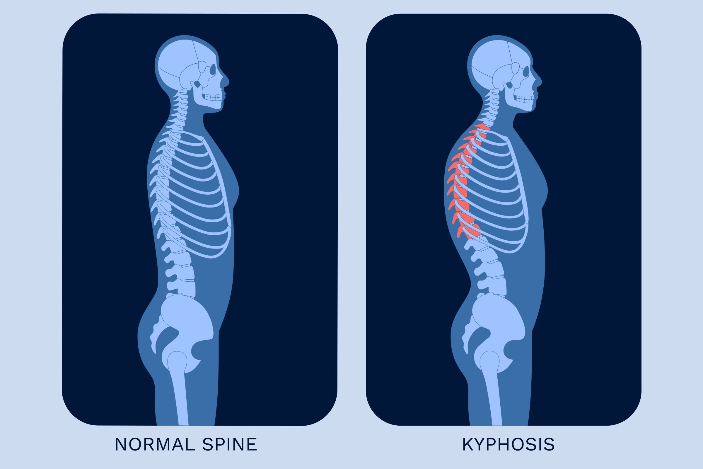 Normal Spine Vs Kyphosis Illustration
