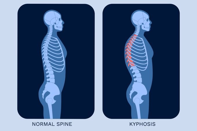 Normal Spine Vs Kyphosis Illustration