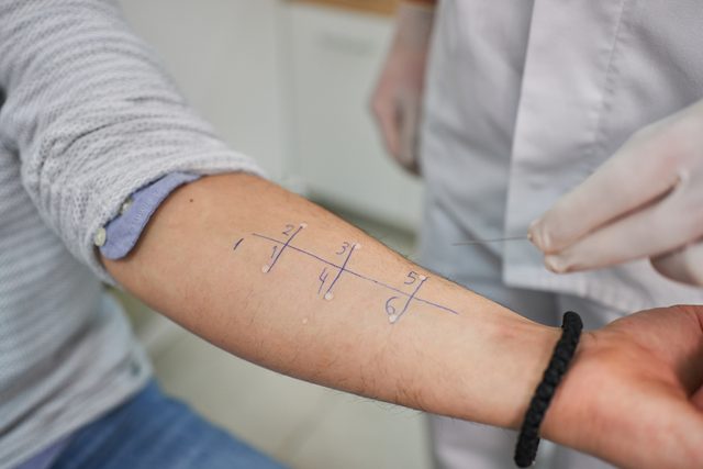 Doctor performing alergy test on a patients arm