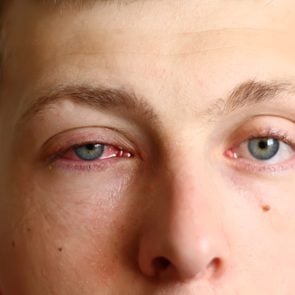 Man with pink eye (conjunctivitis)