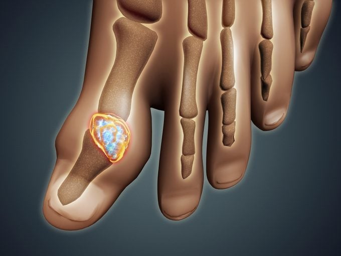 3d medical illustration of gout in big toe