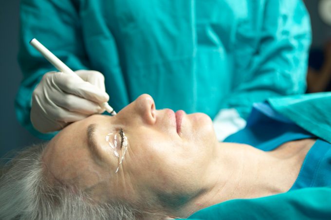 Doctor painting lines on woman's eyes for eye bag surgery