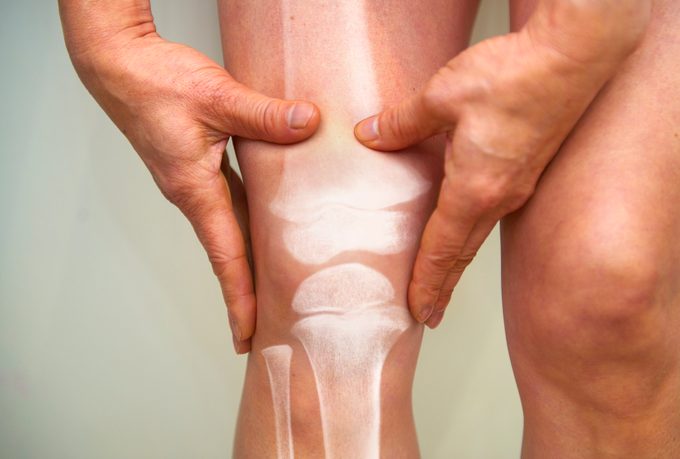 Röntgenfoto van de knie - artrose en reumatoïde artritis