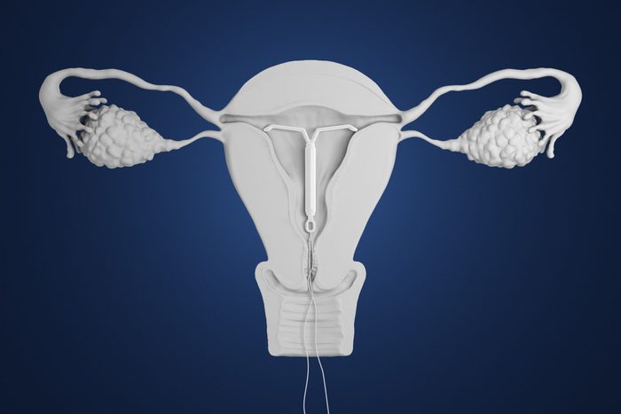 3d rendered intra-uterine device in place inside a cross section of a uterus