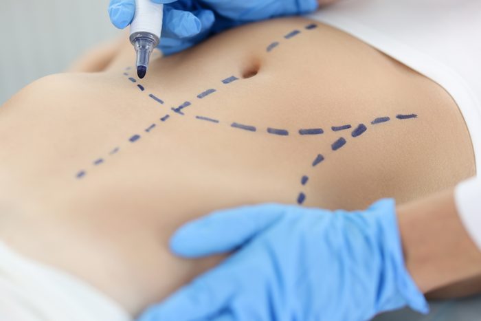 anonymous Doctor plastic surgeon drawing preoperative markings on skin of patient abdomen closeup