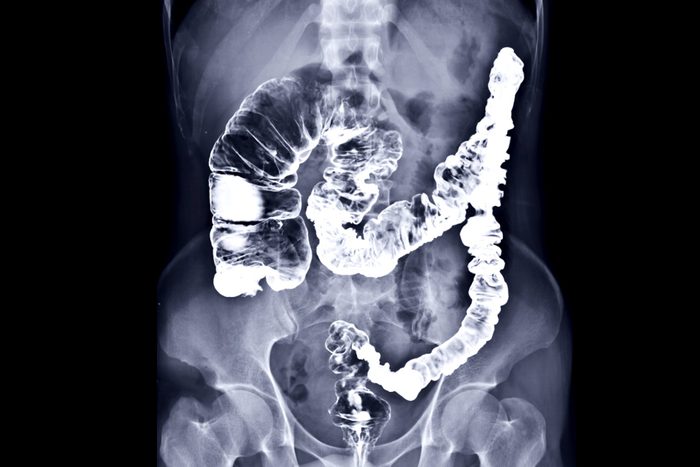B.E. or barium enema image or x-ray image of large intestine AP view showing anatomical of large intestine or colon for diagnosis Colorectal cancer.