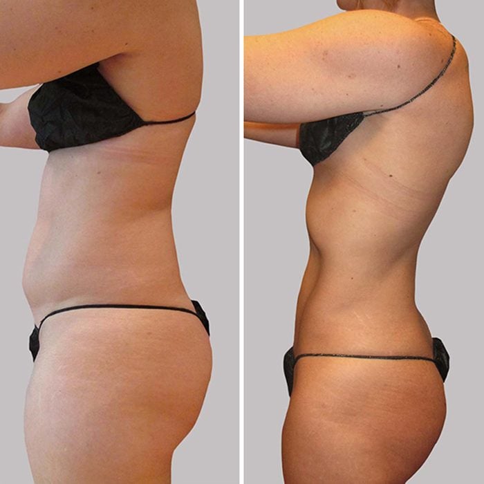 Bann Ba Th Liposuction Before And After Courtesy Sono Bello