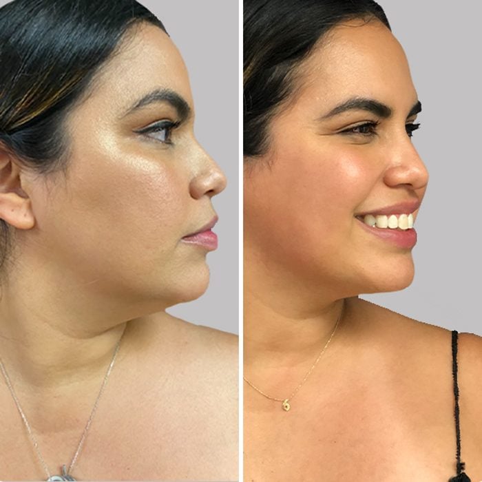 before and after Chin and neck lift