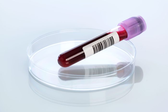 Blood sample in petri dish
