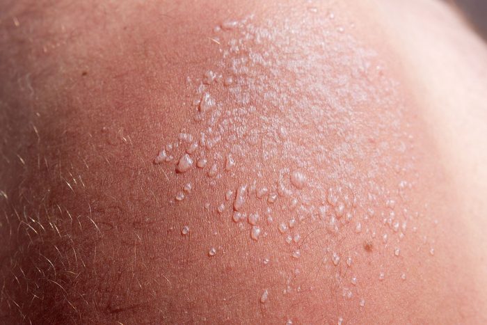 close up of Sun Blisters on a sun burned arm