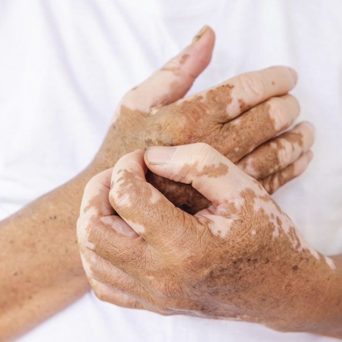 Close-up Vitiligo on skin hands of old people. medical condition causing depigmentation of patches of skin
