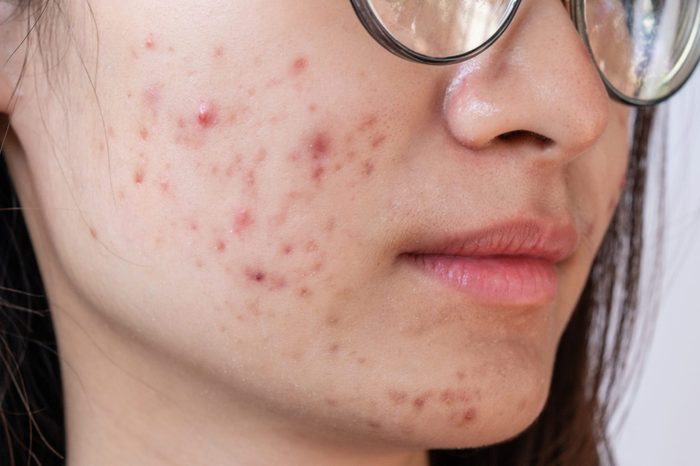 Cropped shot of woman having problems of acne inflamed on her cheek.
