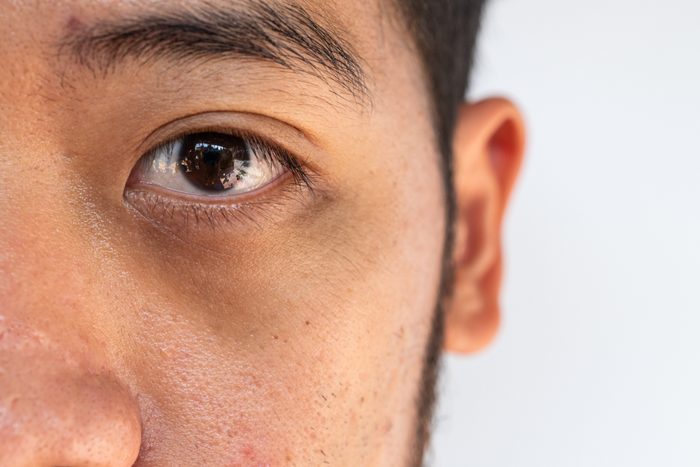 Close up of unhealthy Asian man having under-eye problem such as dark circles and puffiness.