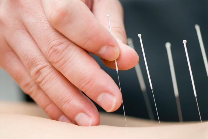 Acupuncture To Lose Weight