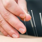 Acupuncture to This Surprising Body Part May Help You Lose Weight, Says New Study