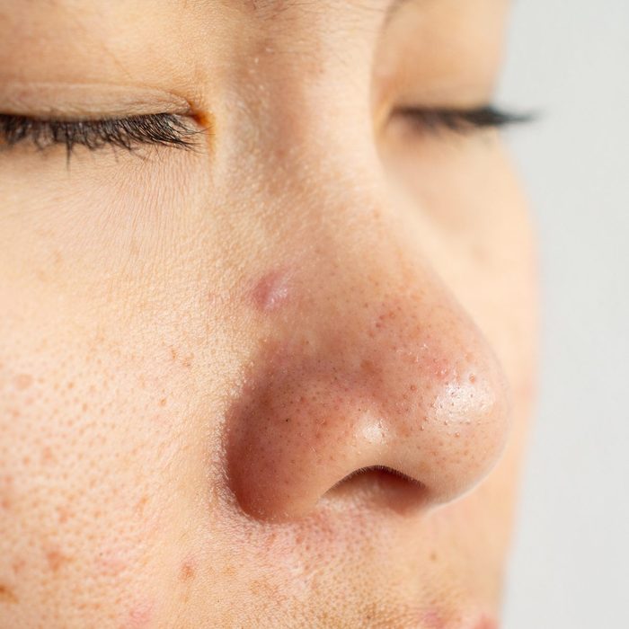 Closeup of woman face with problems of acne inflammation (Papule and Pustule) on her face.