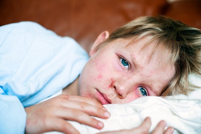 boy with measles in bed