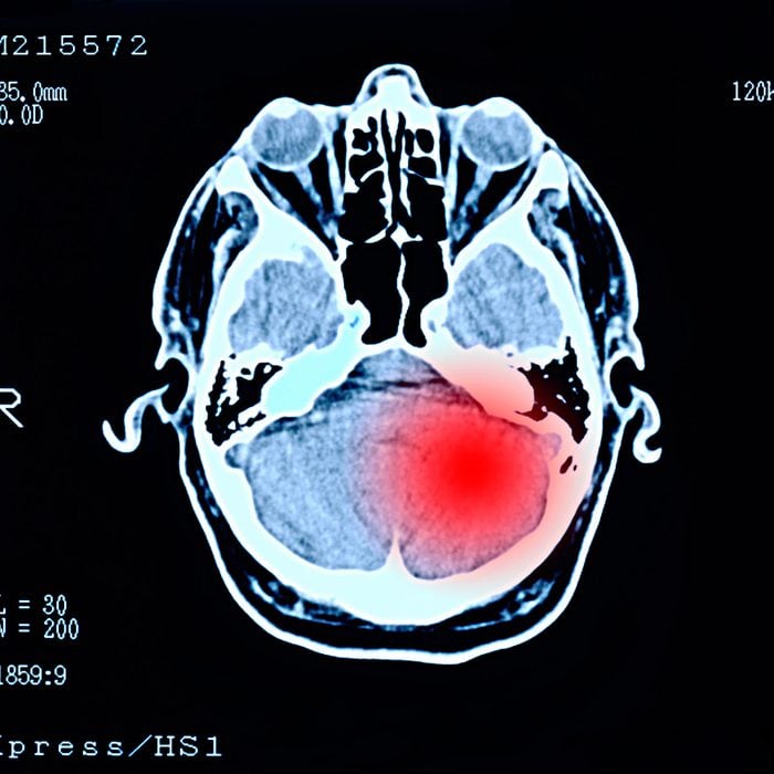 brain tumor scan