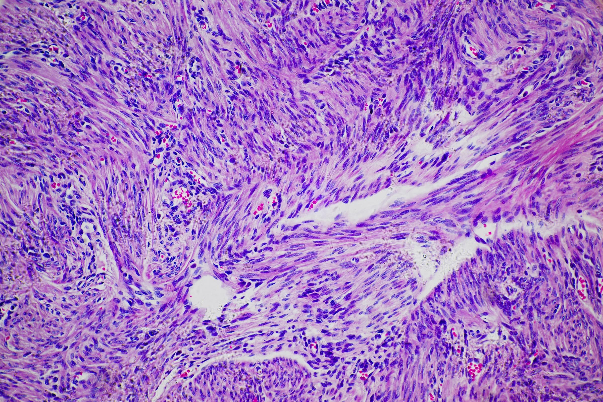 Uterine cancer micrograph -Cancer cells of human leiomyoma uterus tumour|
