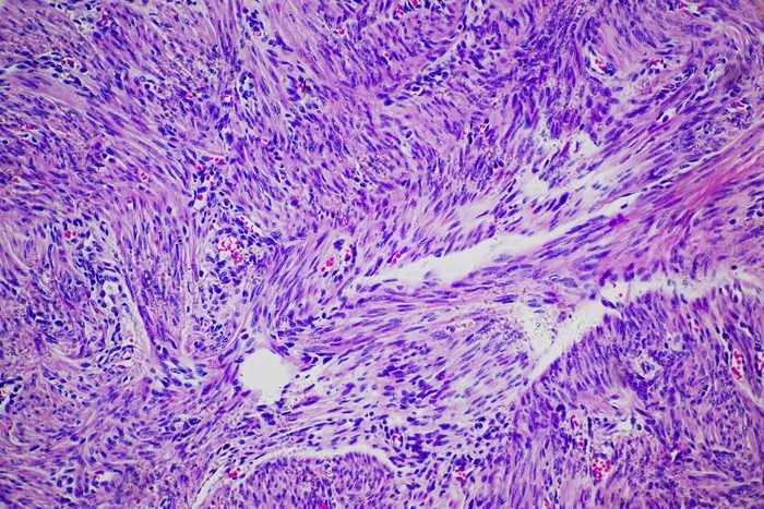 Uterine cancer micrograph -Cancer cells of human leiomyoma uterus tumour