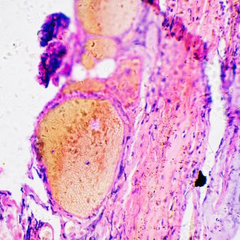 Melanoma cancer cells of human under microscope