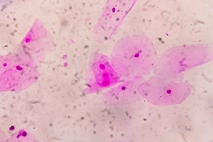 Photomicrograph of gram stain showing Bacterial Vaginosis.