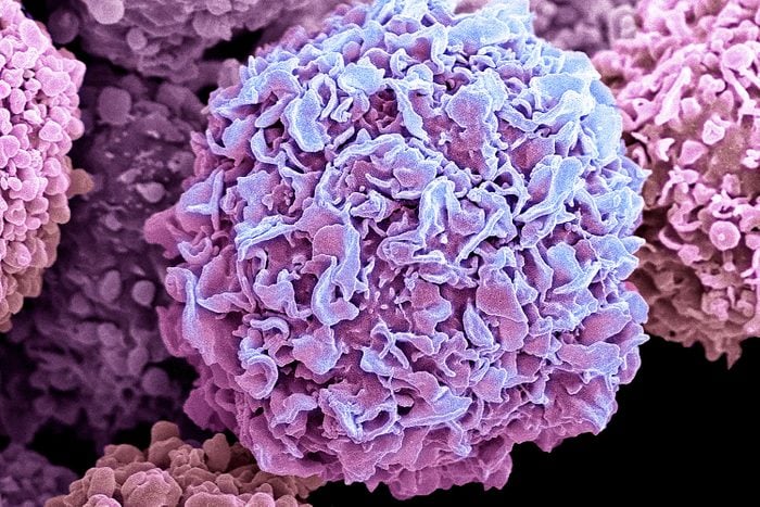 Colored scanning electron micrograph close up of breast cancer cells